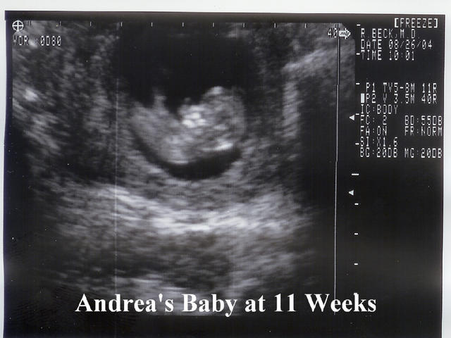 Andrea_s Baby at 11 weeks